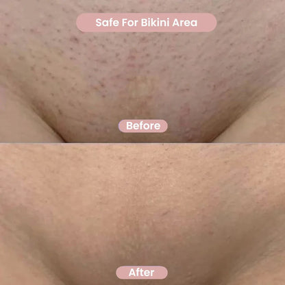Perfect Touch™ Epilator